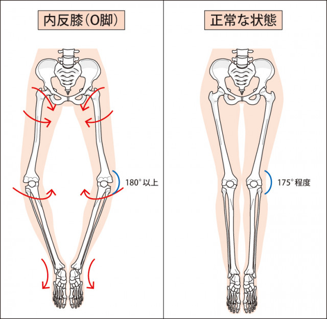 変形性膝関節症とは?